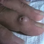 Дерматофиброма на пальце